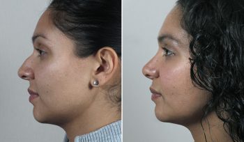 Rhinoplasty Patient 76