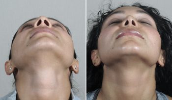 Rhinoplasty Patient 76
