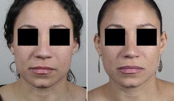 Rhinoplasty Patient 77