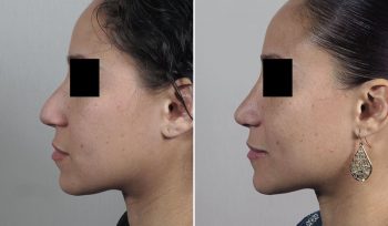 Rhinoplasty Patient 77