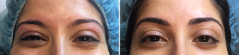 Permanent Makeup Patient 1