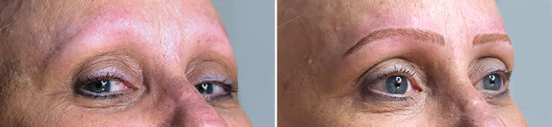 Permanent Makeup Patient 5