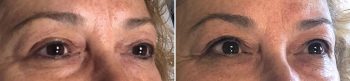 Permanent Makeup Patient 4