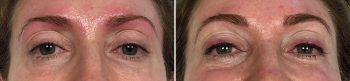 Permanent Makeup Patient 6