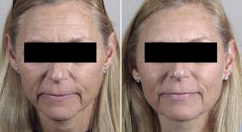 Broadband Light Therapy Patient