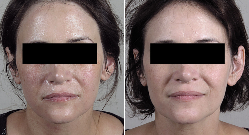 Infini RF Microneedling Patient
