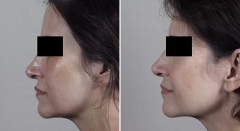 Infini RF Microneedling Patient