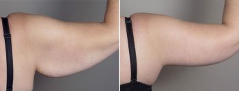 Body Lift Patient 18