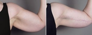 Upper Arm Rejuvenation 15 – Arm Lift