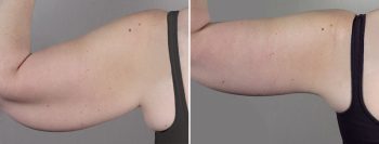 Upper Arm Rejuvenation 15 – Arm Lift
