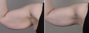 Upper Arm Rejuvenation 15 – Arm Lift