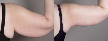 Upper Arm Rejuvenation 15 – Arm Lift