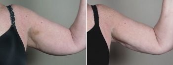 Upper Arm Rejuvenation 16 – Arm Liposuction