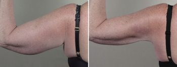 Upper Arm Rejuvenation 16 – Arm Liposuction