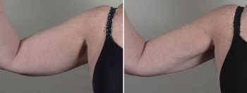 Upper Arm Rejuvenation 16 – Arm Liposuction