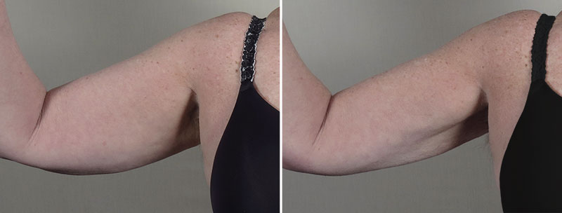 Upper Arm Rejuvenation 16 – Arm Liposuction