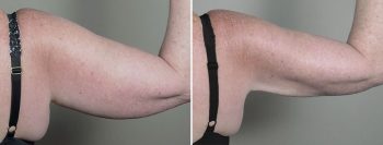 Upper Arm Rejuvenation 16 – Arm Liposuction