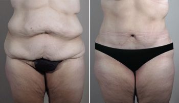 Body Lift Patient 18