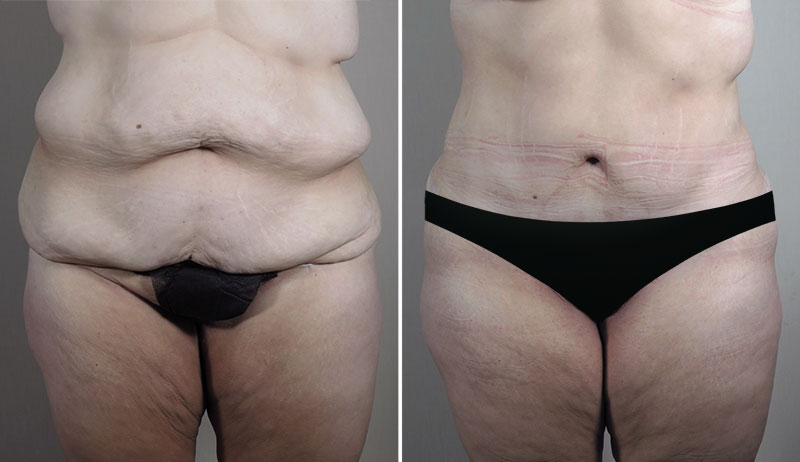 Body Lift Patient 18