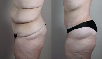 Body Lift Patient 18