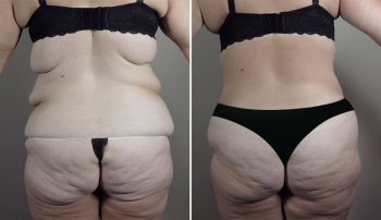 Body Lift Patient 18