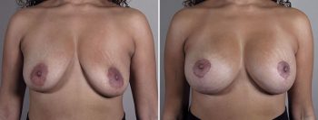 Breast Implant Revision 54