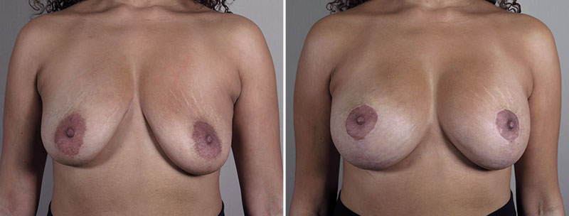 Breast Implant Revision 54