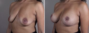 Breast Implant Revision 54