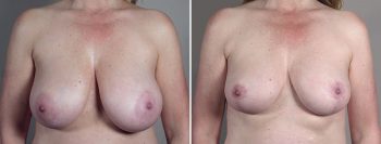 Breast Reduction with Lift: 1