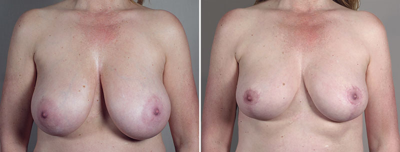 Breast Reduction with Lift: 1
