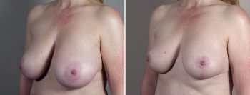 Breast Reduction with Lift: 1
