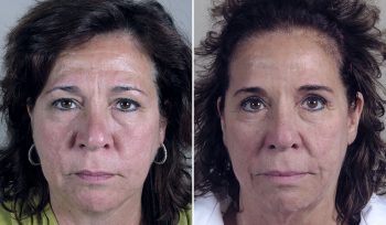 Facelift & Neck lift Patient 37