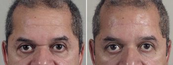 Brow Lift & Lower Eyelid Patient 39