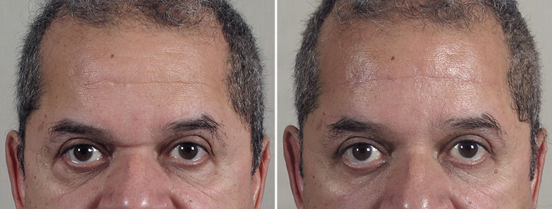 Brow Lift & Lower Eyelid Patient 39