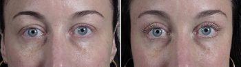 Upper Eyelid Lift Patient 39