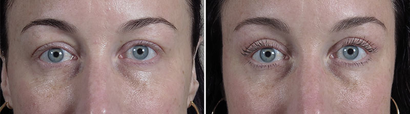 Upper Eyelid Lift Patient 39