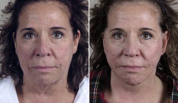 Facelift & Neck lift Patient 37