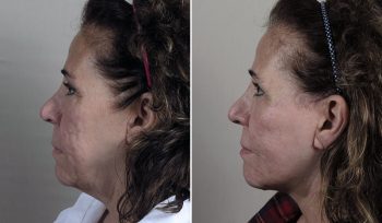 Facelift & Neck lift Patient 37