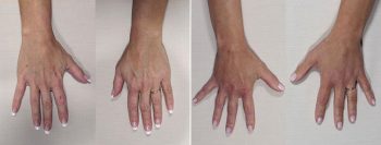 Hand Lift / Fat Transfer 3