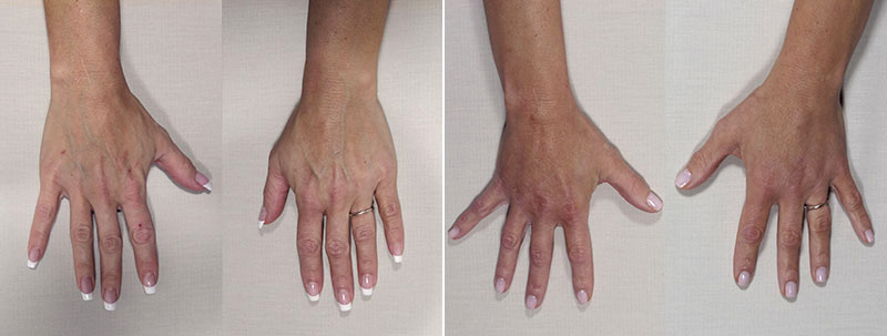 Hand Lift / Fat Transfer 3