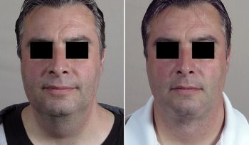 Neck Liposuction Patient 15