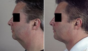 Neck Liposuction Patient 15