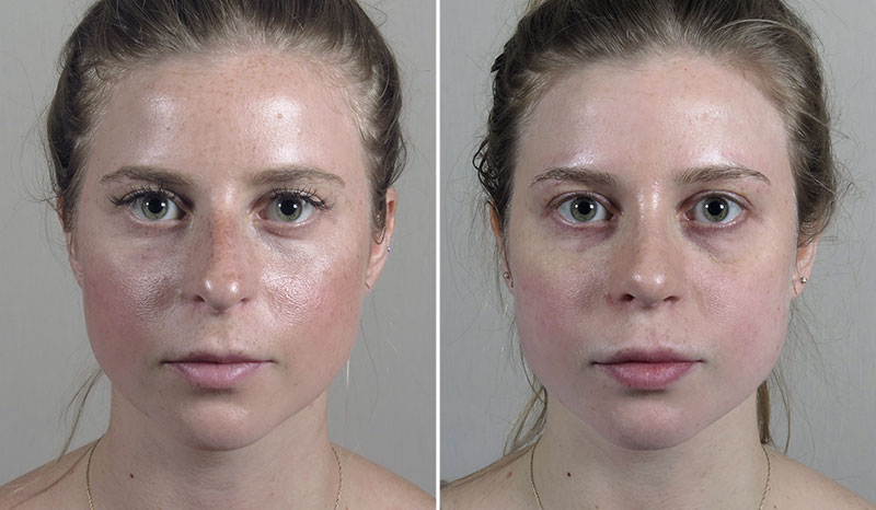 Rhinoplasty Patient 78