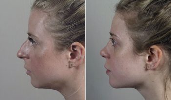Rhinoplasty Patient 78