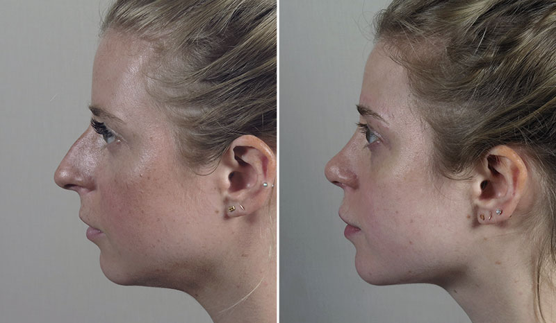 Before & After Open Rhinoplasty Before & After Open Rhinoplasty