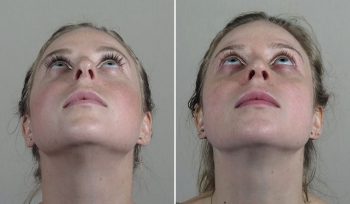 Rhinoplasty Patient 78