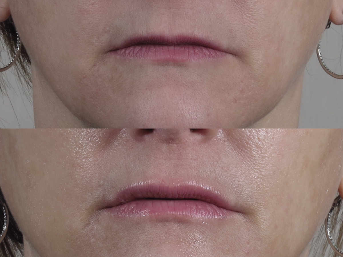 lip microneedling boosts collagen to plump lips without fillers 