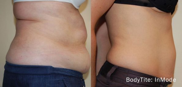 before and after bodytite nonsurgical tummy tightening