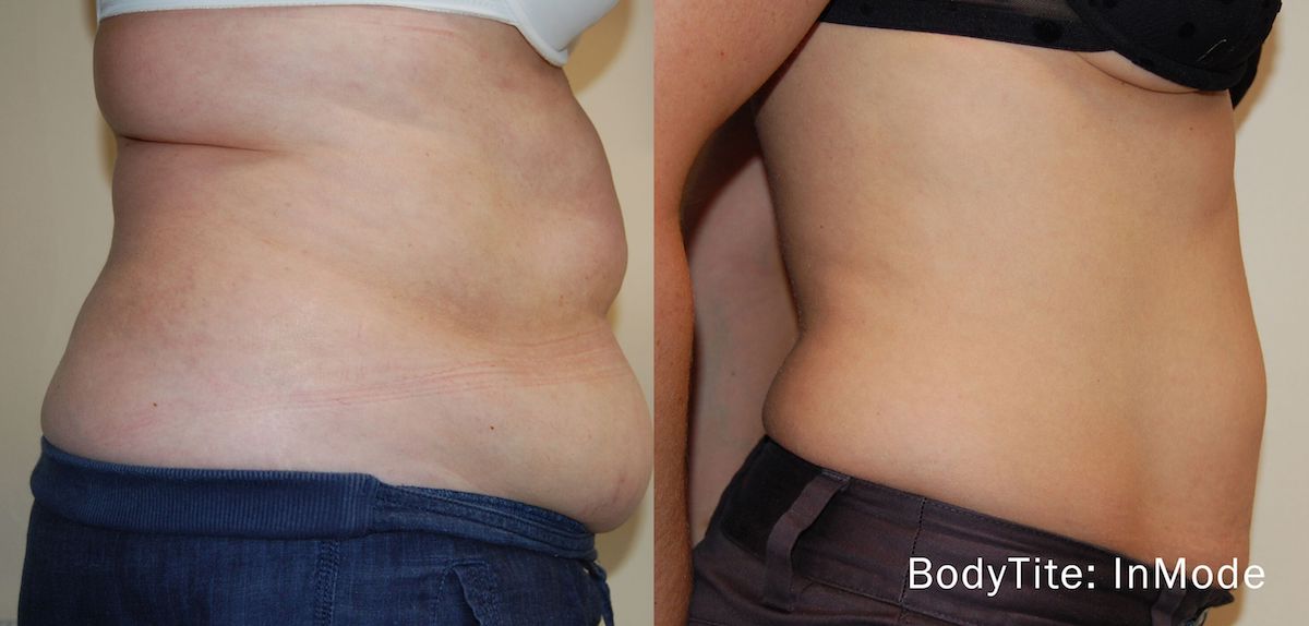 before and after bodytite nonsurgical tummy tightening