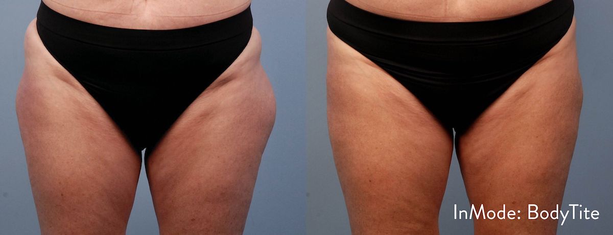 before and after non-surgical thigh lift with bodytite before and after non-surgical thigh lift with bodytite